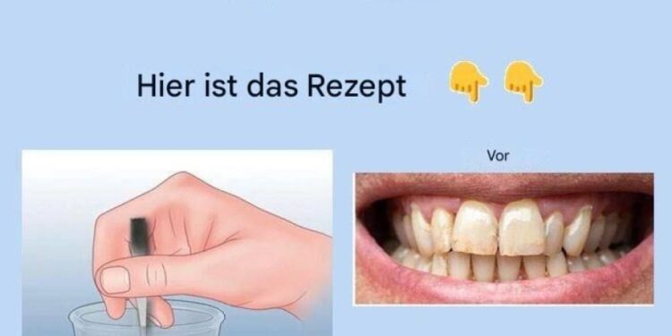 Entfernen Sie Zahnstein und bleichen Sie Ihre Zähne mit diesem einfachen Rezept.