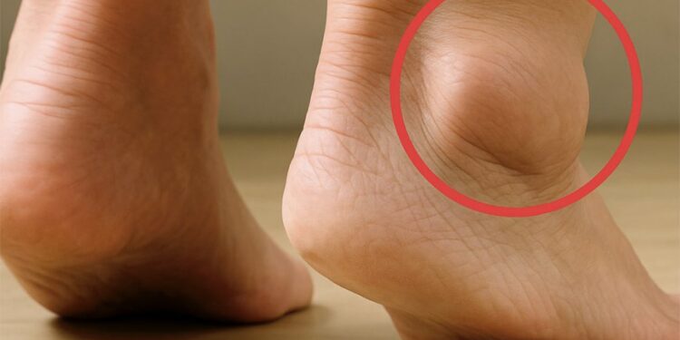 Geschwollene Füße: Was sind die Anzeichen und Lösungen