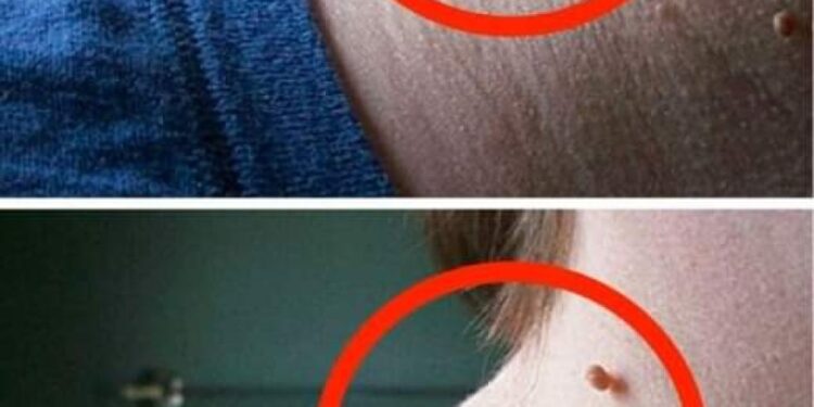 Wie kann man hängende Myome schnell und natürlich aus der Haut entfernen