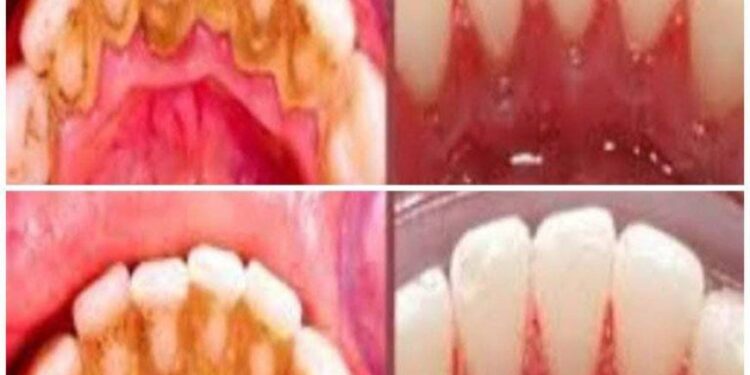 Zahnbelag selbst entfernen: Schnelles und einfaches Hausmittel