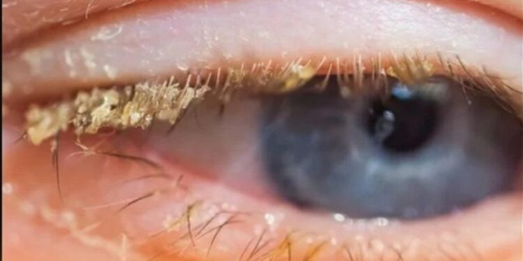 Gelbe Kruste beim Aufwachen: Was bedeutet das?