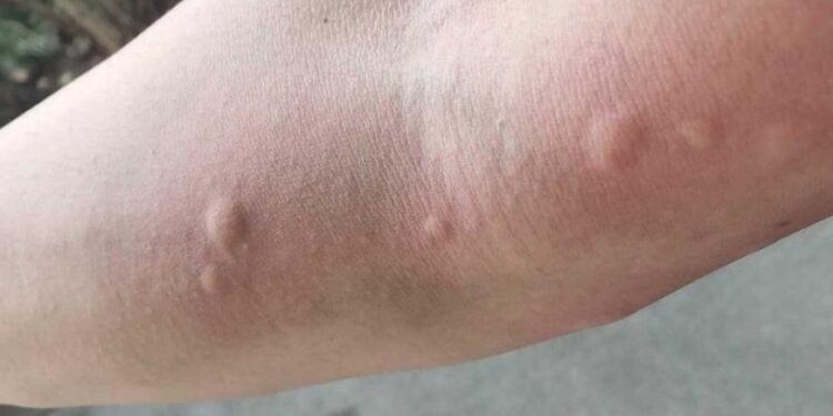 Mein Vater hat mir diesen Trick beigebracht, um Mückenstiche in nur 1 Minute ohne Nebenwirkungen zu stoppen. So funktioniert es