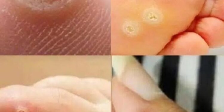 Seien Sie sehr vorsichtig: Wenn Sie dieses Wachstum auf Ihrer Haut bemerken, kann es ernst sein