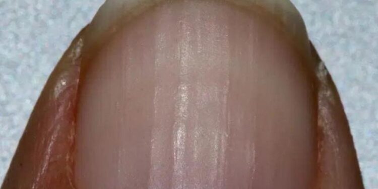 Wenn Sie Rillen auf Ihren Nägeln haben, sagt das etwas über Ihre Gesundheit aus