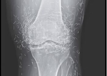Auf dem Röntgenbild der Knie einer Frau sind Hunderte von Goldnadeln zu sehen