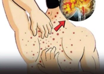 Fettlebererkrankung (Steatose): Ursachen, Symptome, Behandlung und Hausmittel